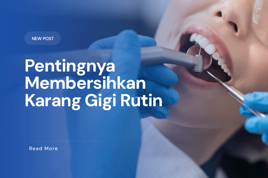 Pentingnya-membersihkan-karang-gigi-secara-rutin